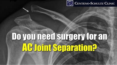 Shoulder Ac Joint Separation Think Twice About Surgery