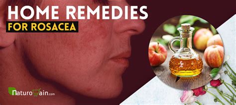 10 Powerful Herbal Remedies For Rosacea Treat Symptoms Naturally