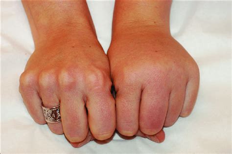 Chronic Lymphedema Involving The Left Hand And Forearm With Swelling