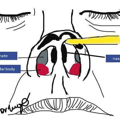 Illustrating The Nasal Vestibular Body In Pink And The Nasal Septal