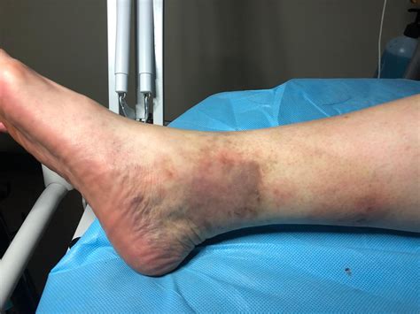 What Is Chronic Venous Insufficiency
