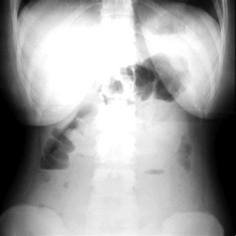 Plain Abdominal Radiograph On Patient Presentation Showed Only Moderate