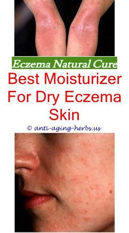 Pin On Best Eczema Treatment For Adults
