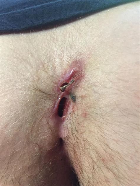 Pilonidal Sinus Before Surgery Nudes By Poutypigeon21