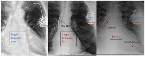 Differentiating Pacemaker Vs Icd On Chest Xray Single Grepmed