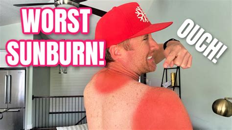 Awesome Day At Beach Ends With Worst Sunburn Ever Ditl Family Of Youtube