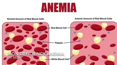 Iron Deficiency Anemia Physiopathology Causes Symptoms Diagnosis And