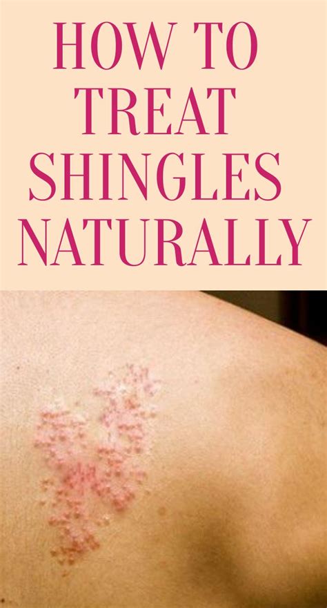 How To Treat Shingles Naturally Shingles Remedies Shingles Treatment