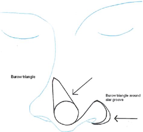 Figure 1 From Crescentic Nasojugal Flap For Nasal Tip Reconstruction