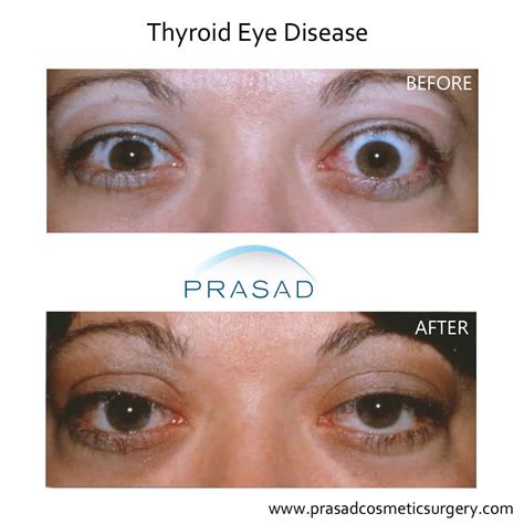 Thyroid Eye Disease Surgery Graves Eye Disease Surgery