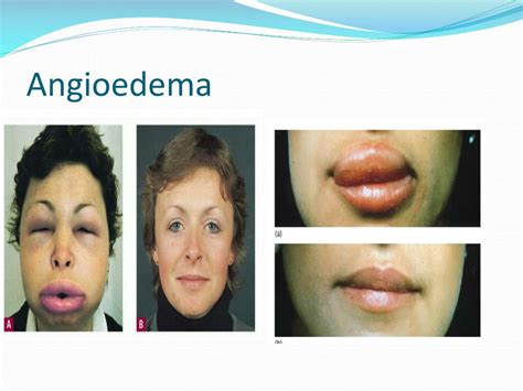 Ppt Allergy Urticaria Angioedema Shock Anaphylactic Powerpoint