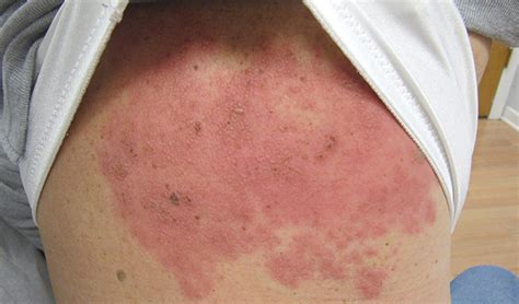 Painful Vesicles Covering The Back And Chest Clinical Advisor