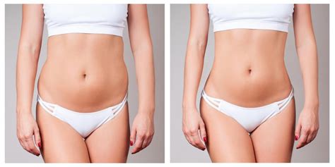 Banish That Stubborn Muffin Top And Love Handles With Warmsculpting By