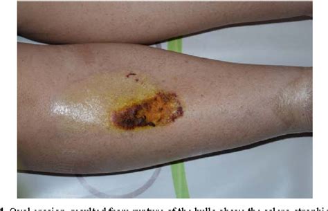 Figure 4 From Extragenital Bullous And Hemorrhagic Lichen Sclerosus In