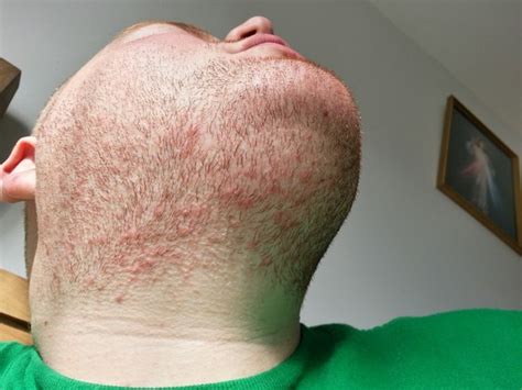 Itching And Red Spots Appearing Whilst Trying To Grow Beard Beard Board