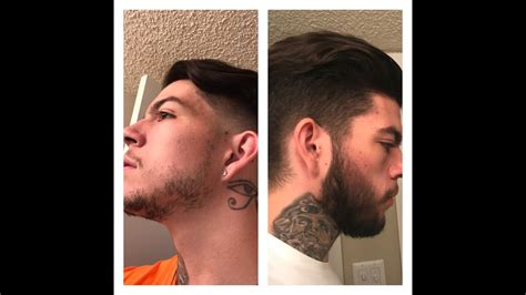% positive response to minoxidil. Minoxidil Before And After Beard Result - How Effective Is ...