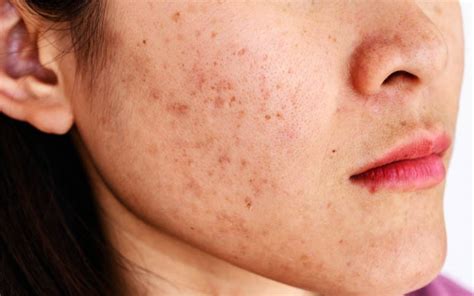 Managing Melasma With Microtherapy All Things Esthetic