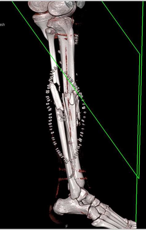 Open Reduction Internal Fixation Orif Of Tibia And Fibular Fractures