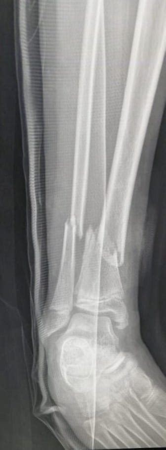 Case Open Tibial Shaft Fracture In An M