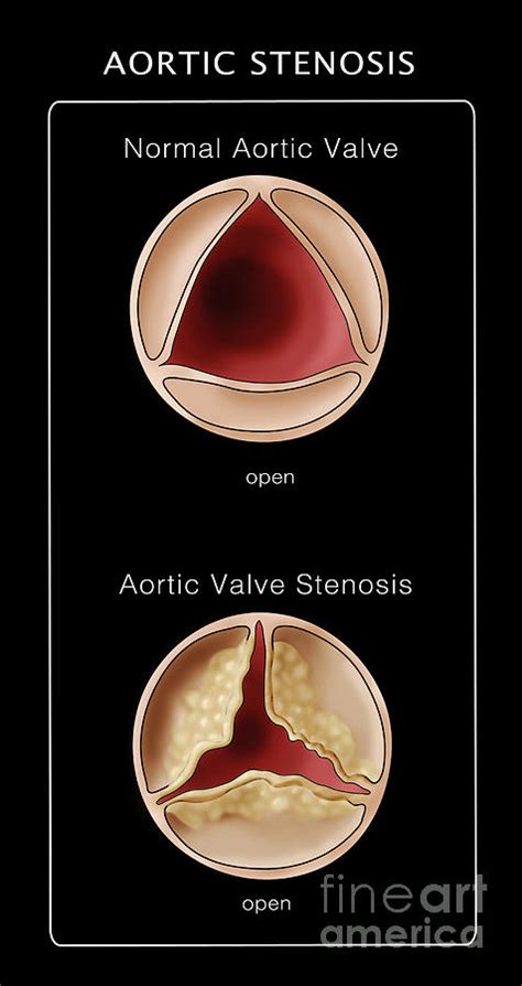 Aortic Valve Normal And Stenosis Photograph By Monica Schroeder Pixels