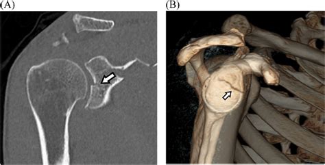 A 37 Year Old Man With Glenoid Fracture Nonenhanced Coronal Ct A And