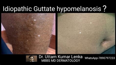 White Spots On Skin In Old Age Idiopathic Guttate Hypomelanosis