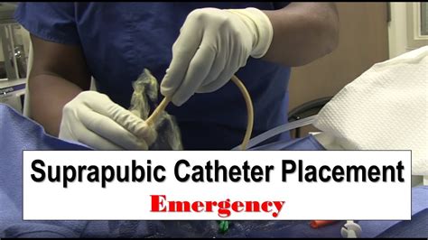 Emergency Suprapubic Catheter Placement YouTube