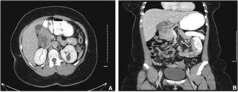Ct Abdomen And Pelvis A With And B Without Contrast Showing