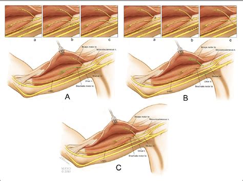 Figure 1 From Factors Associated With Failed Ulnar Nerve Fascicle To