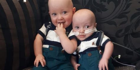 meet the ‘identical twins who were born with a rare life threatening condition which caused