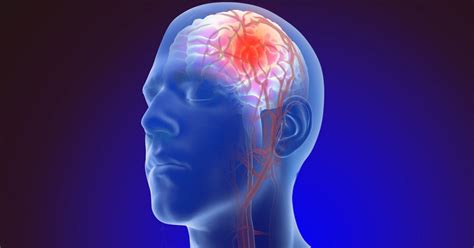 Aneurisma cerebral qué es tipos síntomas y causas frecuentes