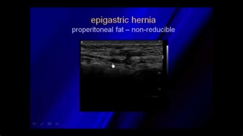 Epigastric Hernia Ultrasound