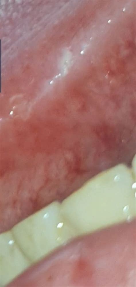 What Is This White Painful Lump On The Side Of My Tongue Diagnoseme