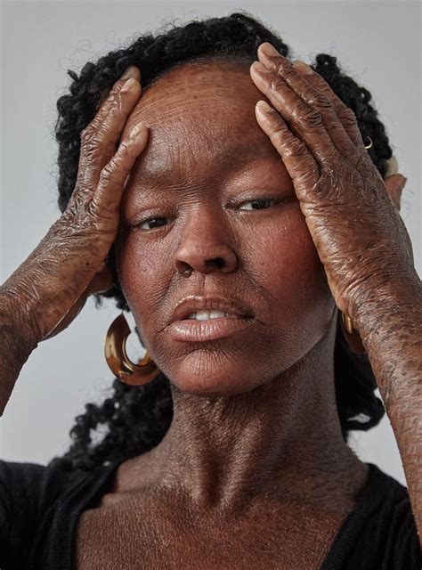 I Never Saw Models With My Skin Condition So I Became One Skin