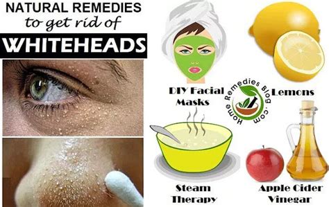 Home Remedies To Get Rid Of Whiteheads