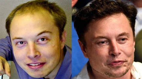 Elon Musk Spent 172 Thousand Dollars On Plastic Surgery And Hair Transplant Before And After