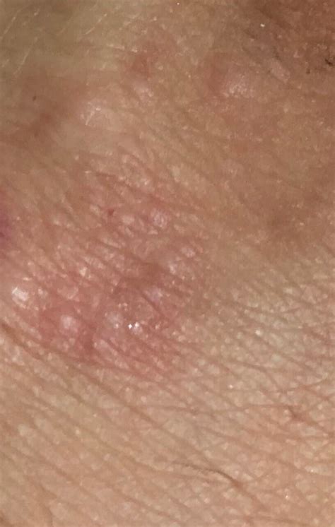 What Are These Bumps On The Back Of My Hand They Dont Itch They Do