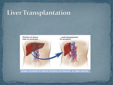 Ppt Liver Transplant Surgery In India Procedure Outcome And Cost