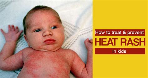 Home Remedies For Heat Rashes In Kids Prevention And Treatment