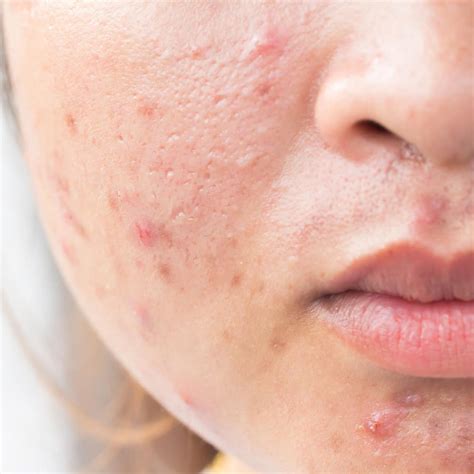 Derm Biome Pharmaceuticals Inflammatory Skin Disease Acne Eczema