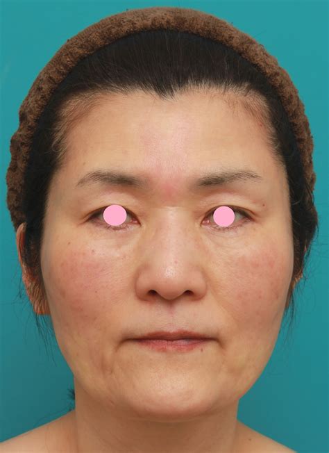 50代後半女性のたるんだ顔に脂肪溶解注射を行って小顔にした症例の経過画像です。 美容整形高須クリニック 高須 幹弥 オフィシャルブログ