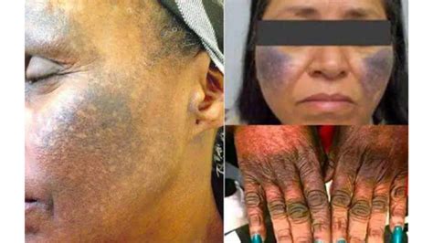 Despite Health Hazards Bleaching Creams Remain Top Taste For Nigerian