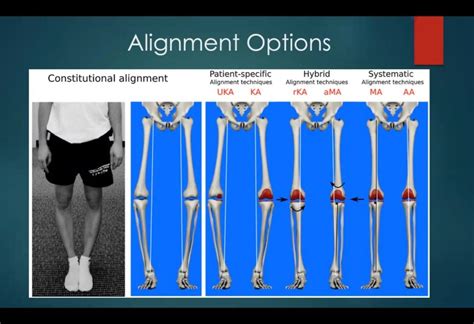 Kinematic Alignment In Tkr Total Knee Replacement Knee Replacement Joint Replacement