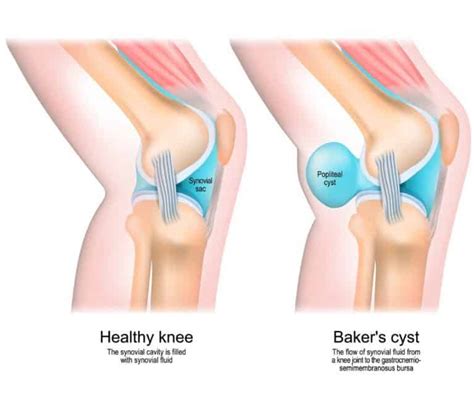 Baker S Cyst Symptoms Causes And Diagnosis Behind The Knee