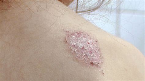 Discoid Eczema 10 Symptoms Of Discoid Eczema