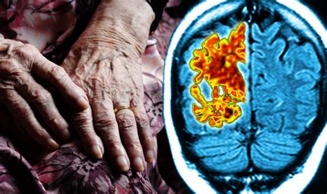 What Is Vascular Dementia Symptoms Causes And Treatment Of The Brain