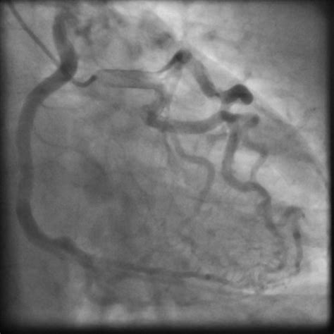 Coronary arteries, and correlating ecg leads in mi. Isolated Anomalous Right Coronary Artery From the ...