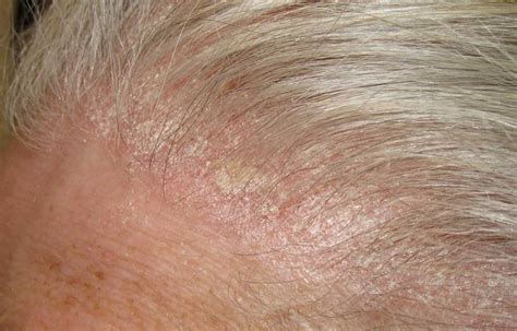 Sores And Scabs On Scalp Pictures Causes And Treatment