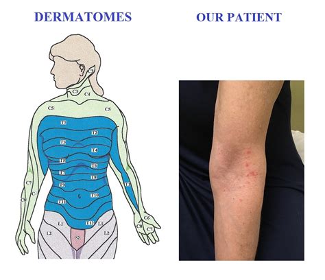 Dermatomes Arm