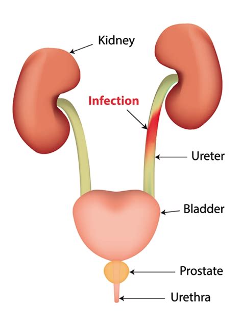 Urinary Tract Infection In Women Complicated Signs And Symptoms Mims Malaysia